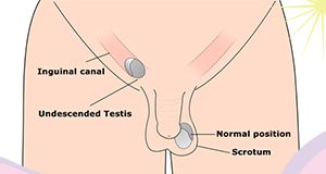 Undescended Testicles